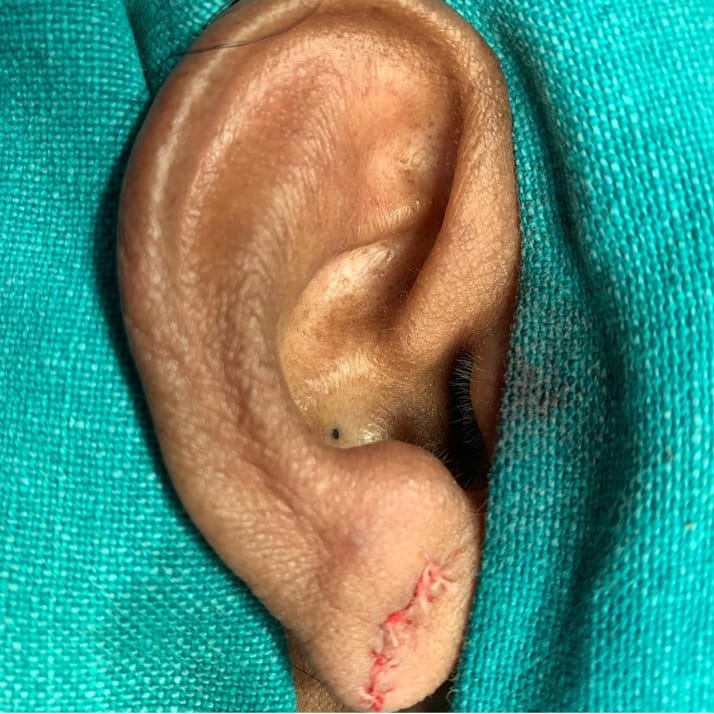 Ear Surgery in nagercoil