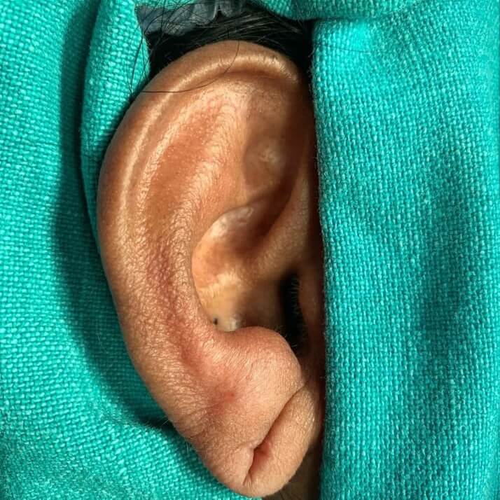 Ear surgery in India