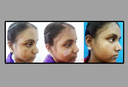 Facial Scar Revision Surgery in India