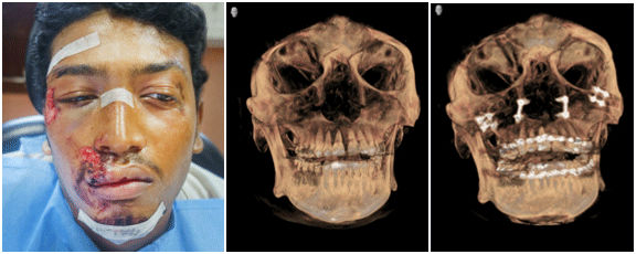 Facial trauma in Tamil Nadu