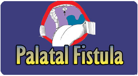 Fistula correction surgery in India