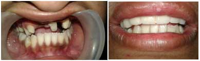 fixed-partial-denture-before-after