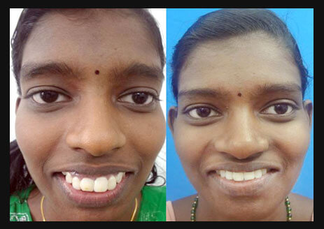 Gummy Smile After and Before Treatment