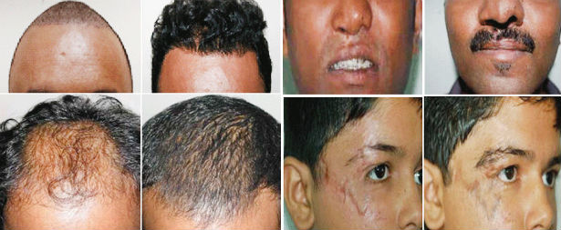 Hair Transplant Treatment in Nagercoil