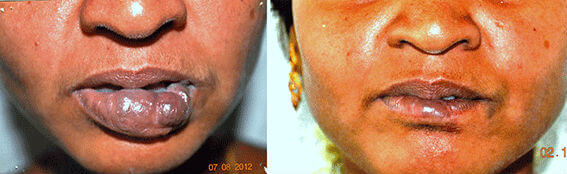 Hemangioma Treatment in Nagercoil