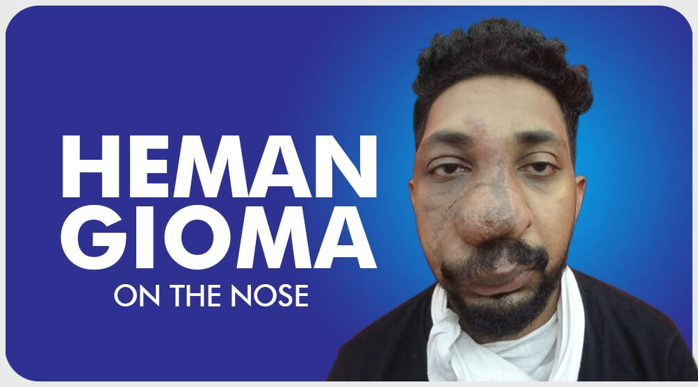 Hemangiomaon the nose