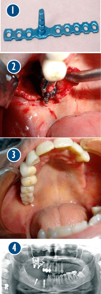 Hybrid Dental Implants surgery in India