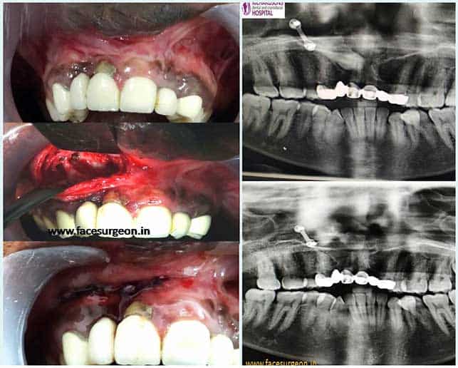 Impacted canine tooth
