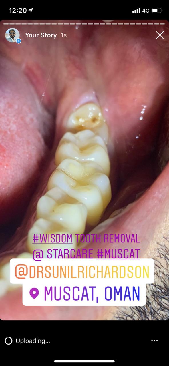 Instagram Reviews Wisdom Teeth Removal