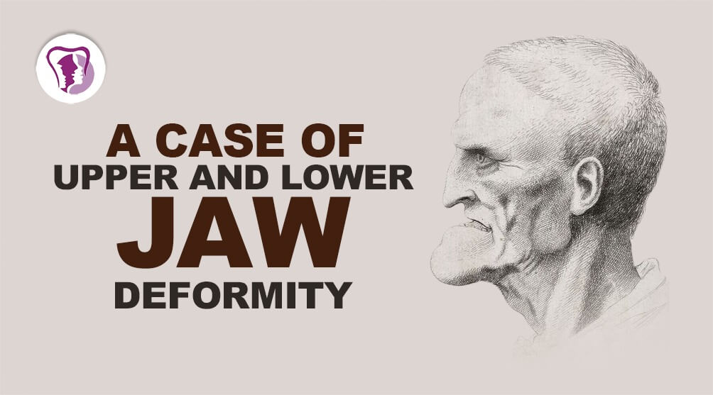 Jaw Deformity Treatment in India