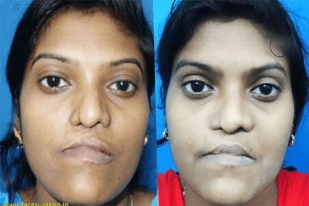 Jaw surgery at Richardsons Hospital India
