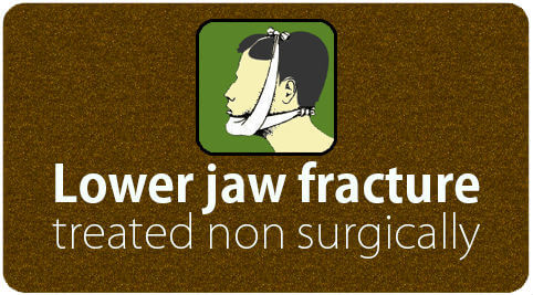Lower jaw fracture treated non surgically