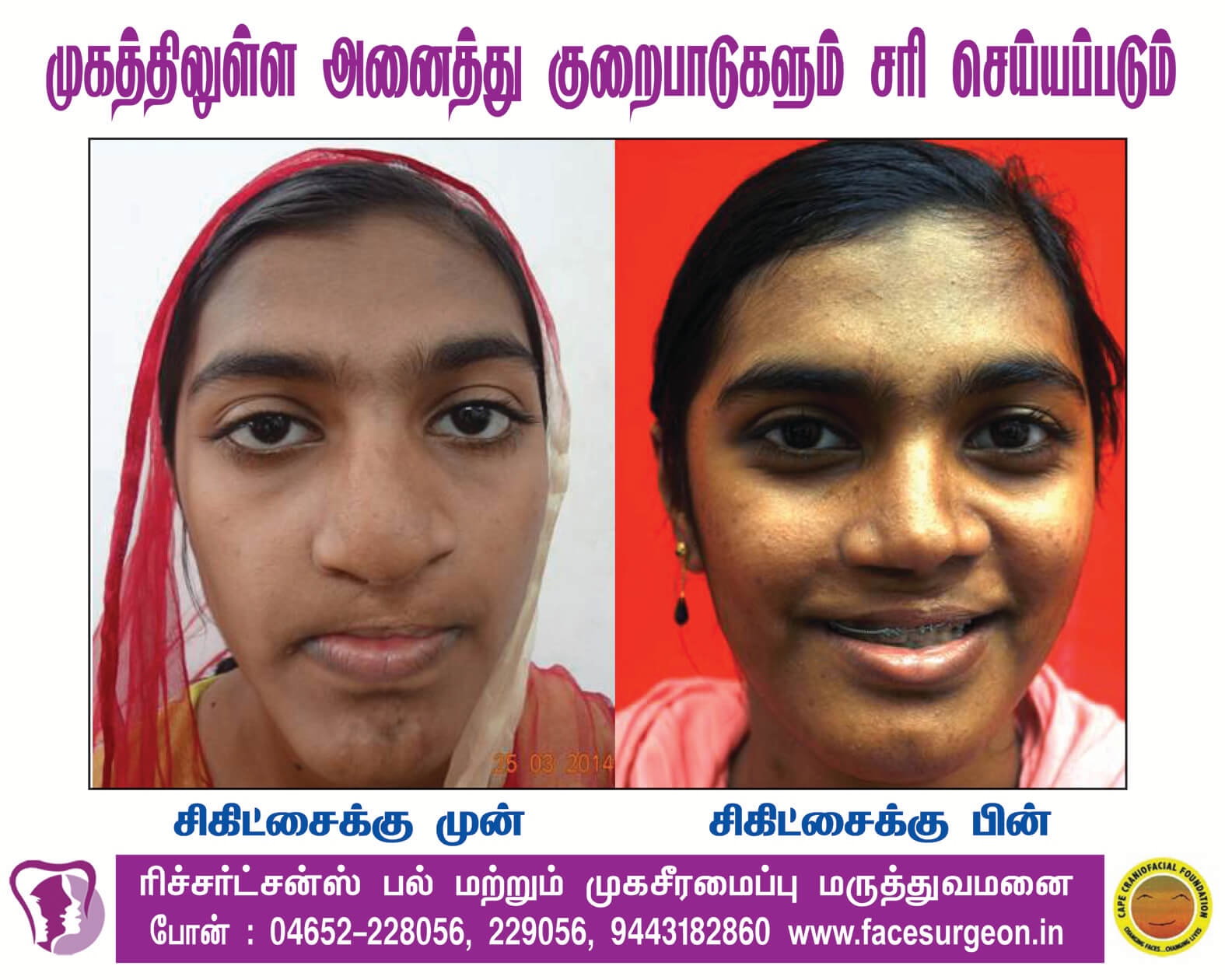Maxillary Distraction Surgery in Nagercoil