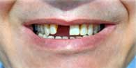 Missing teeth Treatment in India