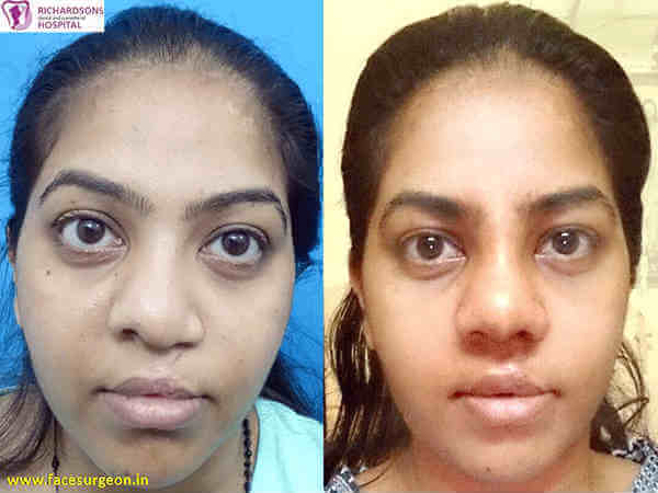 Nose Surgery in Tamil Nadu