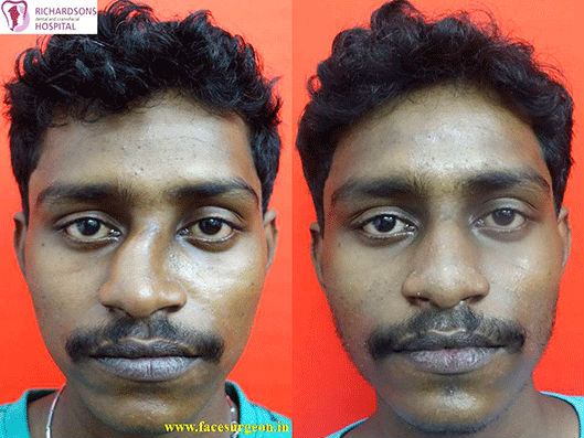 Nose plastic surgery in India