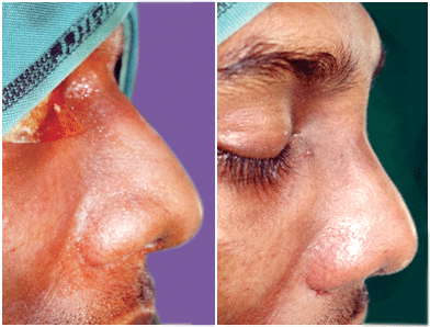 Nose surgery in Nagercoil