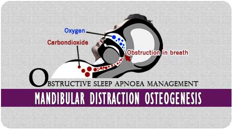 Obstructive sleep apnoea in Richardson dental and craniofacial Hospital
