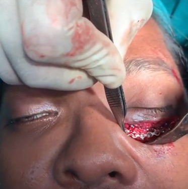 Orbital floor fracture surgery in India