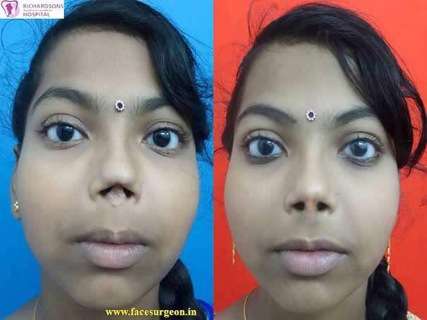 Rhinoplasty Correction in Nagercoil