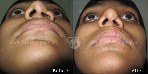 Rhinoplasty-nose-surgery