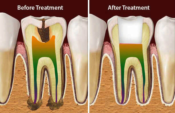 Root Canal Treatment in Nagercoil