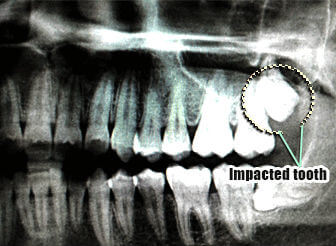dental impaction-cbct