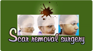 Scar removal surgery in Nagercoil