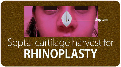 Septal cartilage harvest for Rhinoplasty in India
