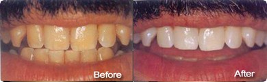 Teeth Whitening and Cleaning Treatment in Nagercoil