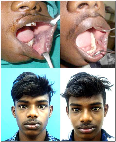 Vascular malformation treatment in India