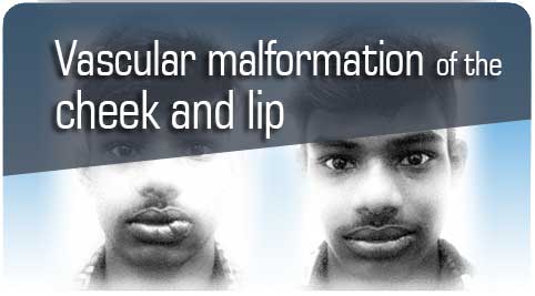 Vascular malformation treatment in Nagercoil