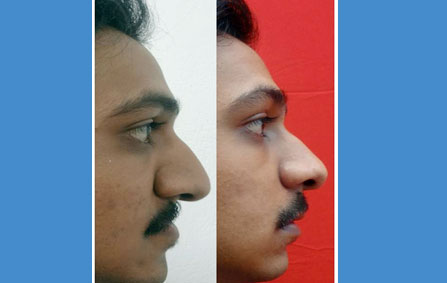 anterior maxillary distraction treatment in India