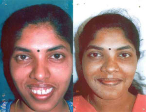 before after orthognathic surgery