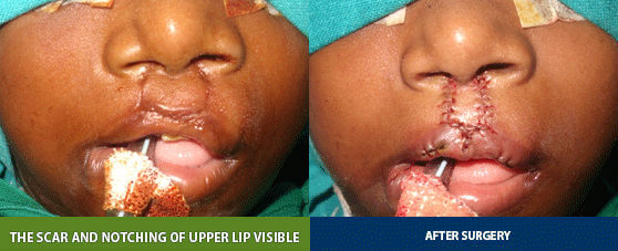 Bilateral Cleft Lip Revision | Richardsons Craniofacial Hospital