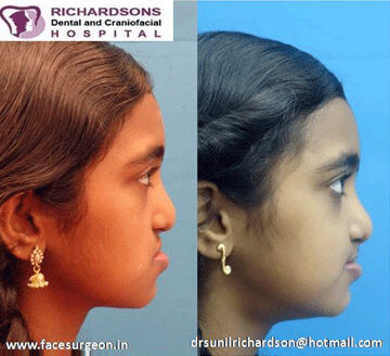 cleft lip and palate surgery in India