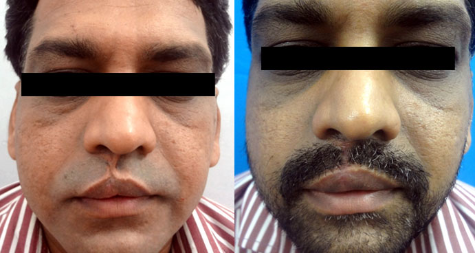 cleft lip surgery in India