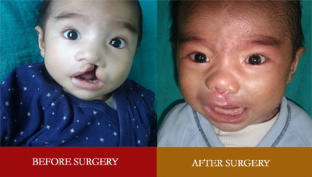 cleft lip surgery in Nagercoil