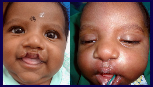 cleft lip surgery in Nagercoil