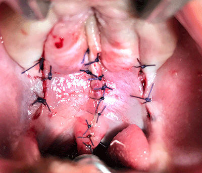 cleft palate treatment