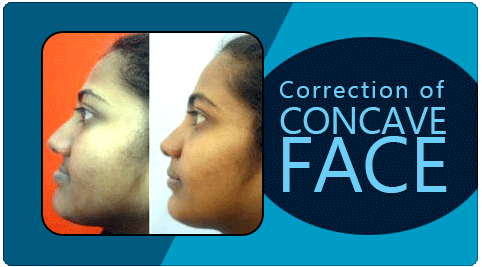concave face correction treatment in India