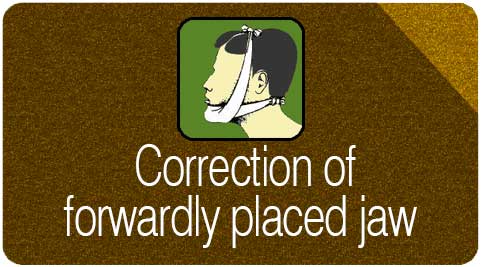 correction of forwardly placed jaw