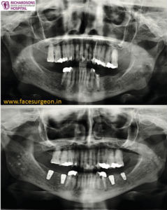 dental implant clinic in india