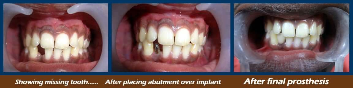 dental implants treatment in Nagercoil