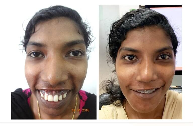 facial correction surgery in Nagercoil
