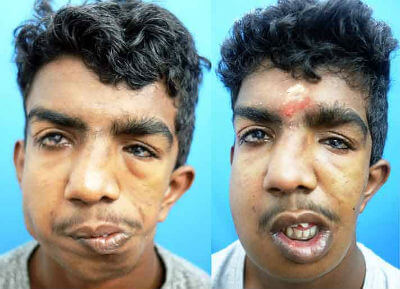 faciomaxillary surgery in India