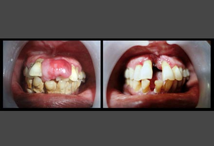gingival growth