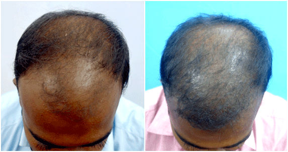 hair transplant(PRP) treatment in Tamil Nadu