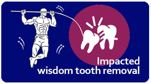impacted teeth removal