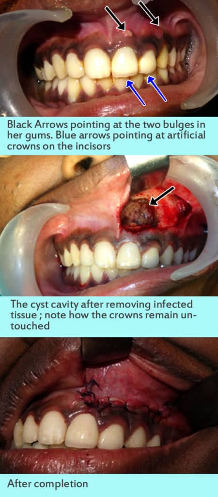 maxillary cyst removal treatment in Nagercoil